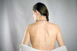 Did you know the history of this deadly disease?